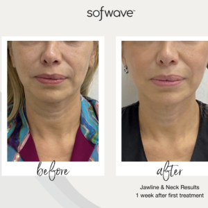 Discover Sofwave the award-winning ultrasound treatment for lifting the face and neck, and reducing wrinkles