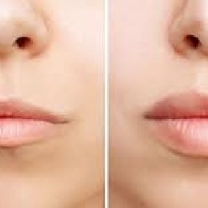 The Lip Flip: A Subtle Beauty Enhancement with Dr. Carniciu at NY Eye and Face