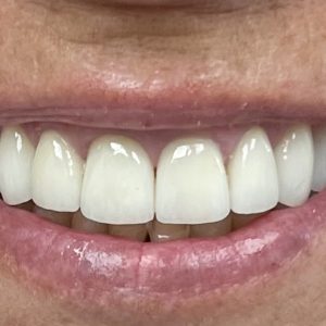 Your STUNNING Smile With Porcelain Veneers with Dr. Stan Heifetz